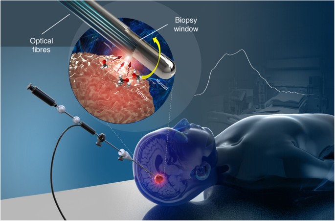 Belay Diagnostics Validates New MGMT Test for Brain Cancer Detection Belay Diagnostics Validates New MGMT Test for Brain Cancer Detection