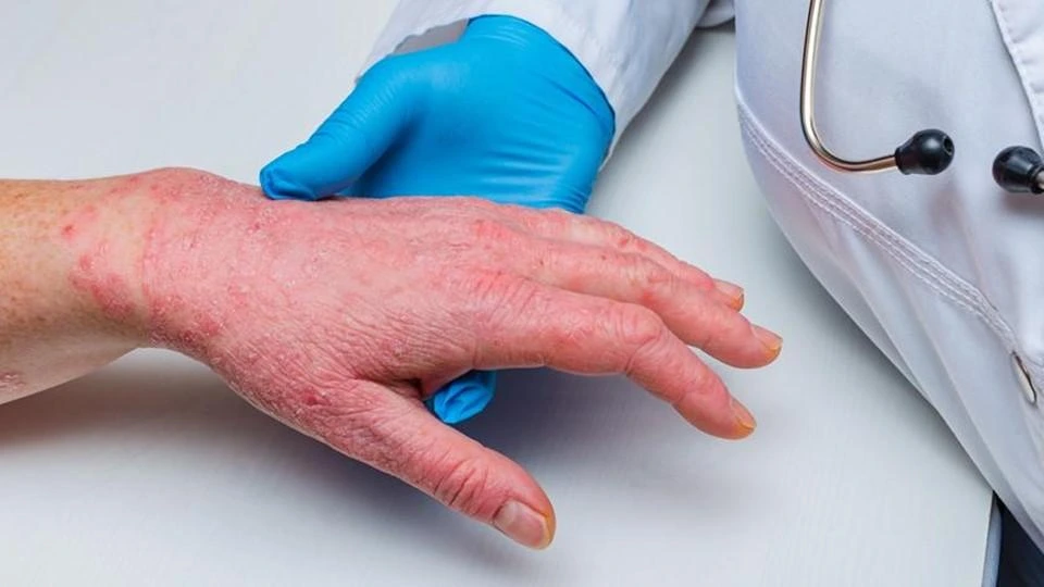 Leo Pharma advances CHE treatment Leo Pharma advances CHE treatment